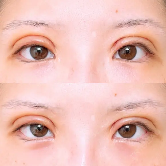 二重切開 アネシス美容クリニック DAY 4 メイン用