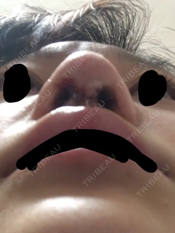 鼻尖形成（切開） 三輪皮フ科形成外科 DAY 1 メイン用