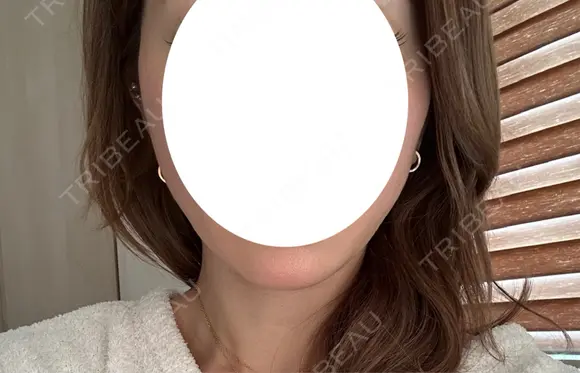 糸リフト Stand by Beauty Clinic DAY 3 メイン用