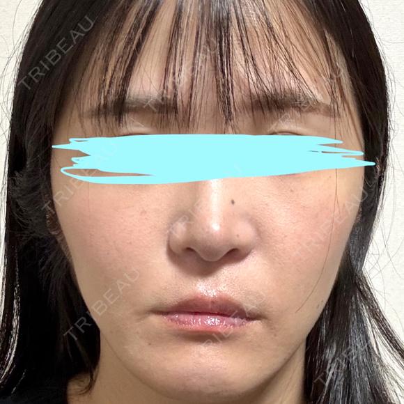 小鼻縮小（切開） / 鼻翼基部形成（貴族手術） 新宿ラクル美容外科クリニック 新宿院 AFTER メイン用