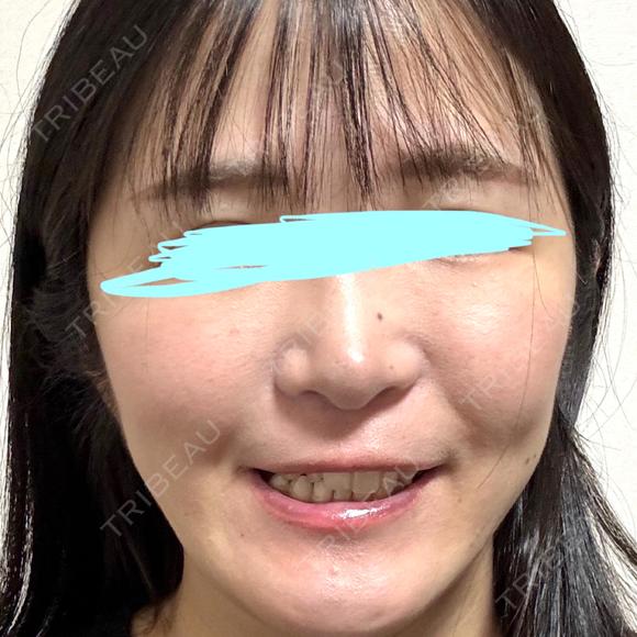 小鼻縮小（切開） / 鼻翼基部形成（貴族手術） 新宿ラクル美容外科クリニック 新宿院 DAY 93 メイン用