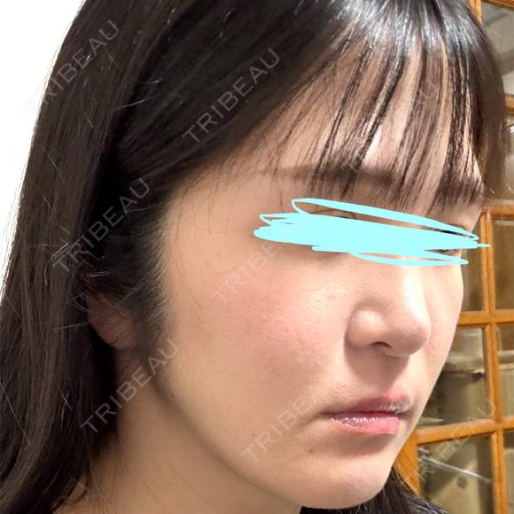 小鼻縮小（切開） / 鼻翼基部形成（貴族手術） 新宿ラクル美容外科クリニック 新宿院 DAY 93 メイン用