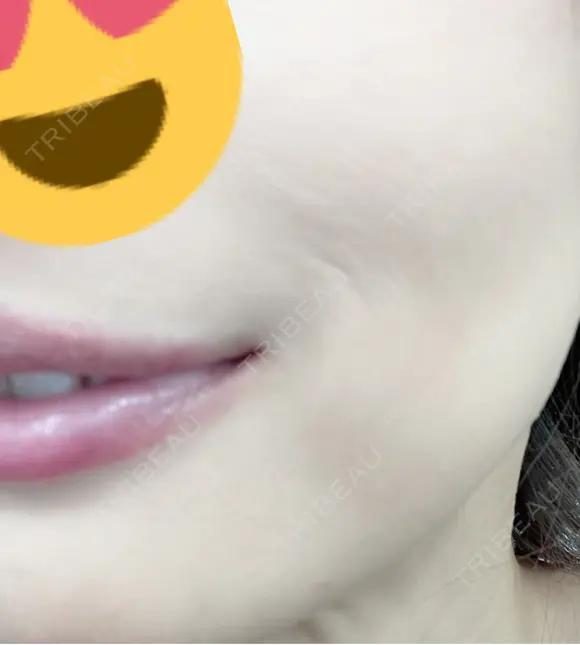 ボトックス（口角） / ワキ汗治療（ボトックス） DMTC CLINIC 日本橋院 AFTER メイン用