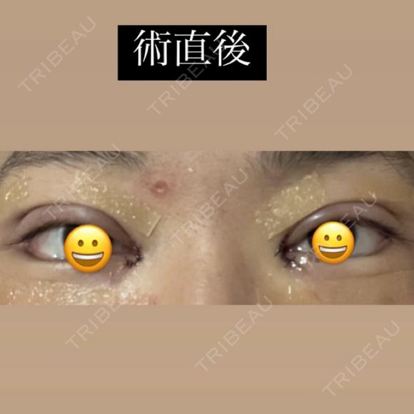 目頭切開 / 目尻切開 / 自然癒着法 LUHO（ルホ）美容外科 DAY 37 メイン用