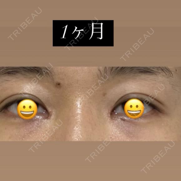 目頭切開 / 目尻切開 / 自然癒着法 LUHO（ルホ）美容外科 DAY 37 メイン用