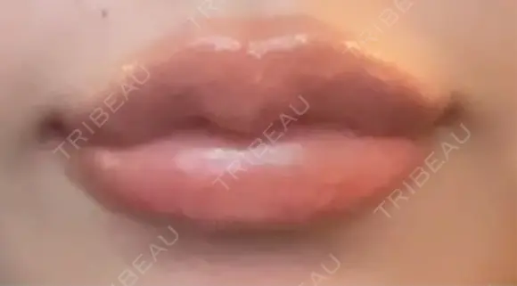 ヒアルロン酸注入（涙袋） / ヒアルロン酸注入（唇） / ボトックス（口角） ルラ美容クリニック 名古屋本院 DAY 1 メイン用