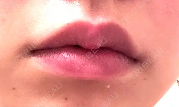 ボトックス（口角） / ボトックス（肩） DMTC CLINIC 日本橋院 DAY 3 メイン用