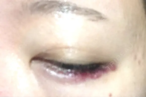 ヒアルロン酸注入（涙袋） アネシス美容クリニック DAY 4 メイン用