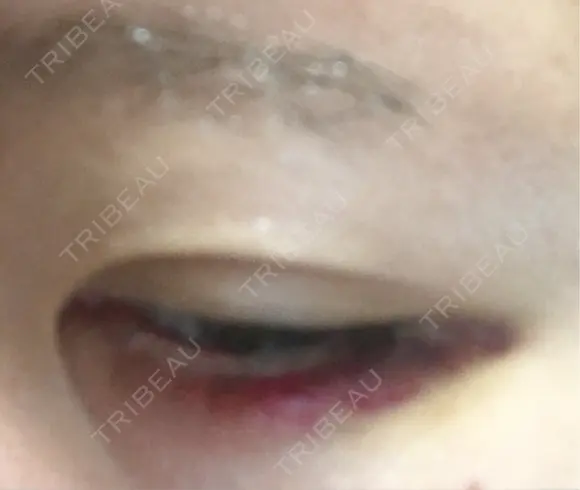 ヒアルロン酸注入（涙袋） アネシス美容クリニック DAY 5 メイン用