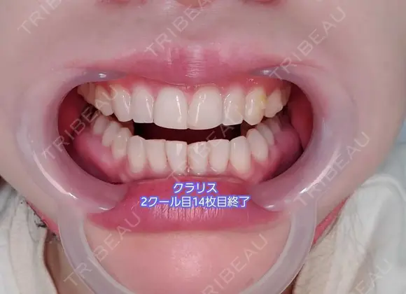 矯正（マウスピース） オーラルビューティークリニック クラリス審美歯科・矯正歯科 DAY 251 メイン用