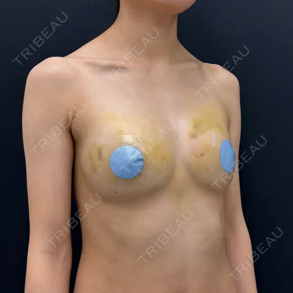 豊胸（脂肪注入） 湘南美容クリニック 吉祥寺院 DAY 9 メイン用