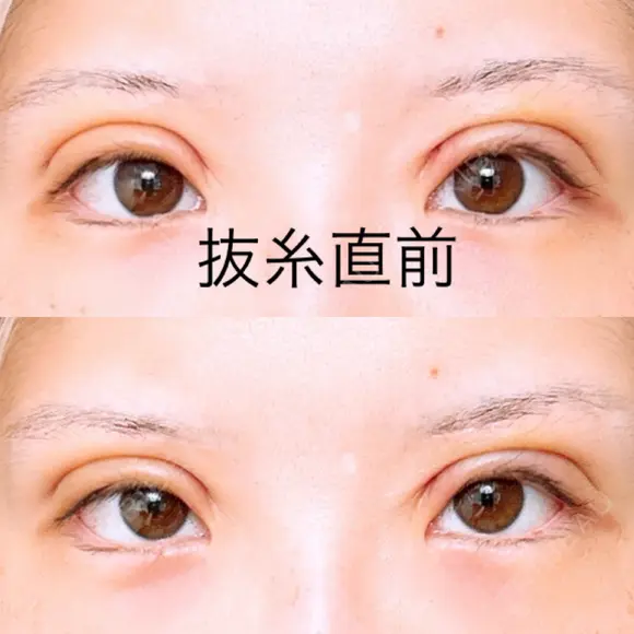 二重切開 アネシス美容クリニック DAY 5 メイン用