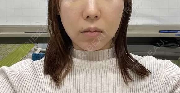 ボトックス（エラ・小顔） ルラ美容クリニック 名古屋本院 DAY 3 メイン用