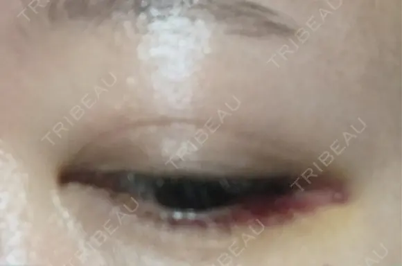 ヒアルロン酸注入（涙袋） アネシス美容クリニック DAY 6 メイン用