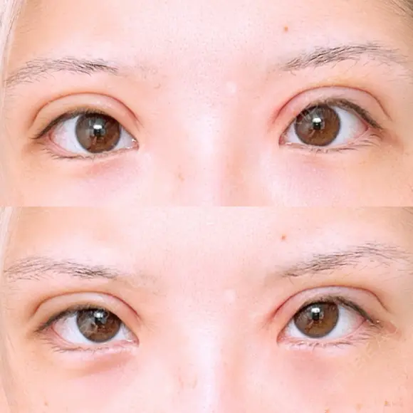 二重切開 アネシス美容クリニック DAY 6 メイン用