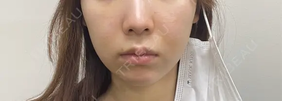 ボトックス（エラ・小顔） ルラ美容クリニック 名古屋本院 DAY 4 メイン用