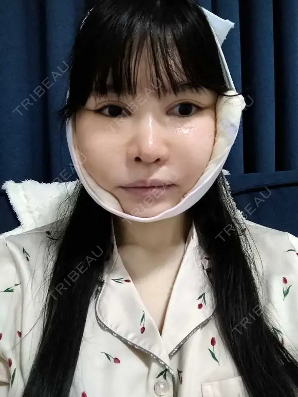 鼻修正 / 切開リフト / 鼻翼基部形成（貴族手術） リッツ美容外科 東京院 DAY 24 メイン用