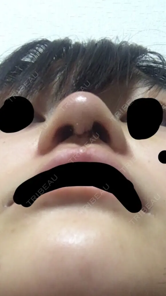 鼻尖形成（切開） 三輪皮フ科形成外科 DAY 3 メイン用