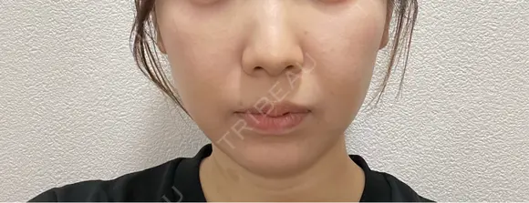 脂肪吸引（顔） ルラ美容クリニック 名古屋栄院 / ルラスキンクリニック 名古屋栄院 DAY 7 メイン用