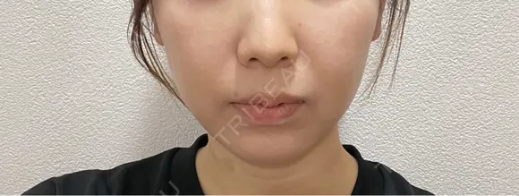 ボトックス（エラ・小顔） ルラ美容クリニック 名古屋本院 DAY 5 メイン用