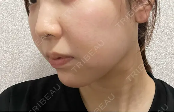 脂肪吸引（顔） ルラ美容クリニック 名古屋栄院 / ルラスキンクリニック 名古屋栄院 DAY 7 メイン用