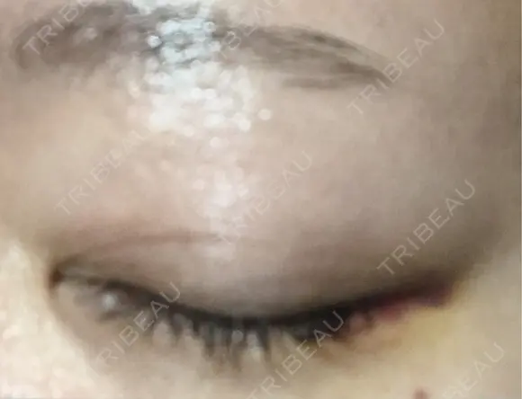 ヒアルロン酸注入（涙袋） アネシス美容クリニック DAY 7 メイン用