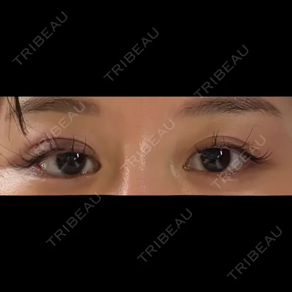 二重埋没 / 眼瞼下垂（非切開） SOL CLINIC DAY 0 メイン用