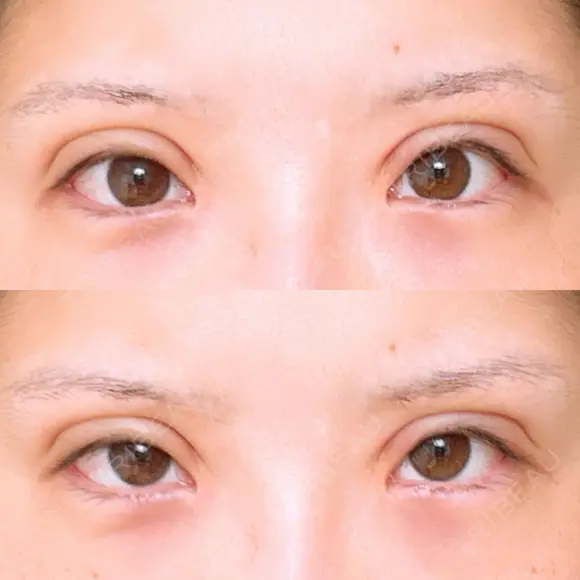 二重切開 アネシス美容クリニック DAY 7 メイン用