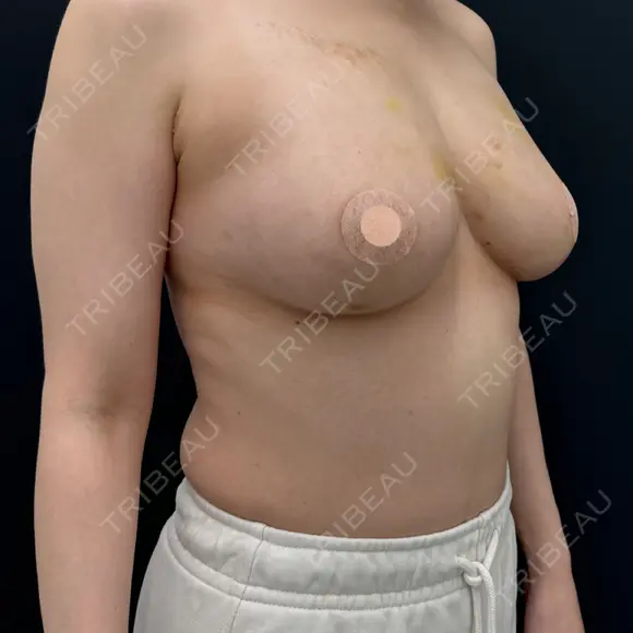 脂肪吸引（脚） / 豊胸（脂肪注入） / 脂肪注入（目の下） 湘南美容クリニック 吉祥寺院 DAY 28 メイン用