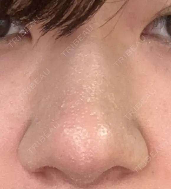 鼻尖形成（切開） / 軟骨移植 / 鼻柱下降・鼻唇角形成（猫手術） 東京美専クリニック DAY 8 メイン用