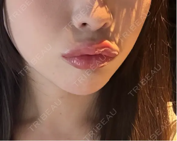 ヒアルロン酸注入（唇） Code Beauty Clinic 名古屋院 DAY 0 メイン用