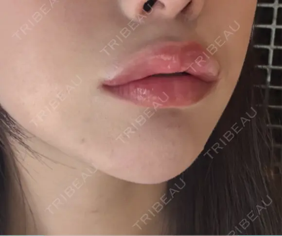 ヒアルロン酸注入（唇） Code Beauty Clinic 名古屋院 DAY 0 メイン用