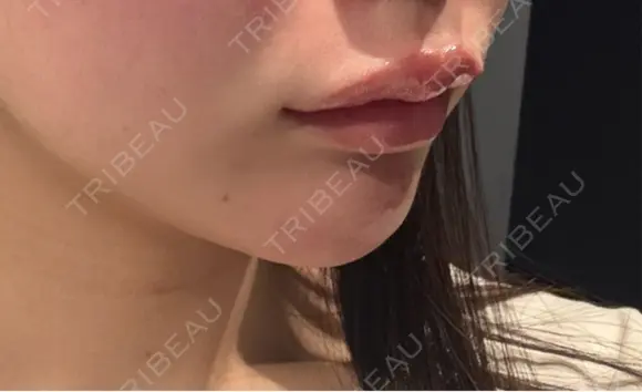 ヒアルロン酸注入（唇） Code Beauty Clinic 名古屋院 DAY 0 メイン用