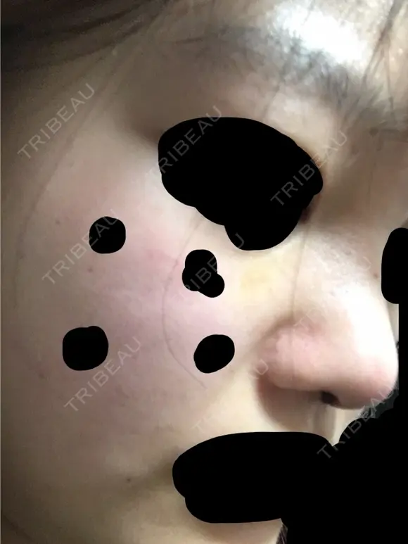 鼻尖形成（切開） 三輪皮フ科形成外科 DAY 4 メイン用