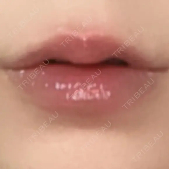 ヒアルロン酸注入（唇） AZ BEAUTY CLINIC AFTER メイン用