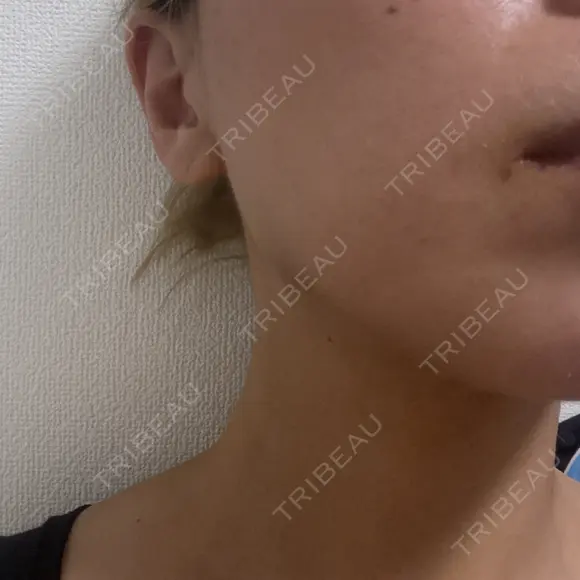 RF（高周波）たるみ治療 大美会クリニック 梅田院 AFTER メイン用