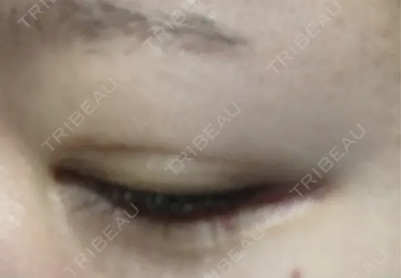 ヒアルロン酸注入（涙袋） アネシス美容クリニック DAY 9 メイン用