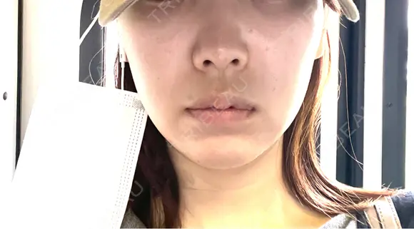 脂肪吸引（顔） ルラ美容クリニック 名古屋栄院 / ルラスキンクリニック 名古屋栄院 DAY 9 メイン用