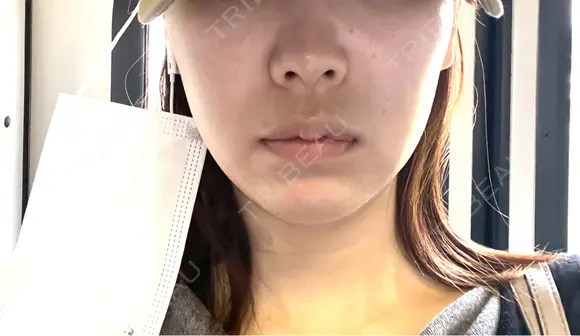 ボトックス（エラ・小顔） ルラ美容クリニック 名古屋本院 DAY 7 メイン用