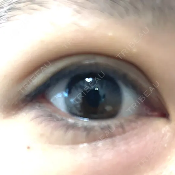 二重埋没 / 自然癒着法 Brandnew Beauty Clinic AFTER メイン用