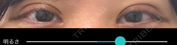 二重切開 / 目頭切開 eクリニック 大阪院 AFTER メイン用