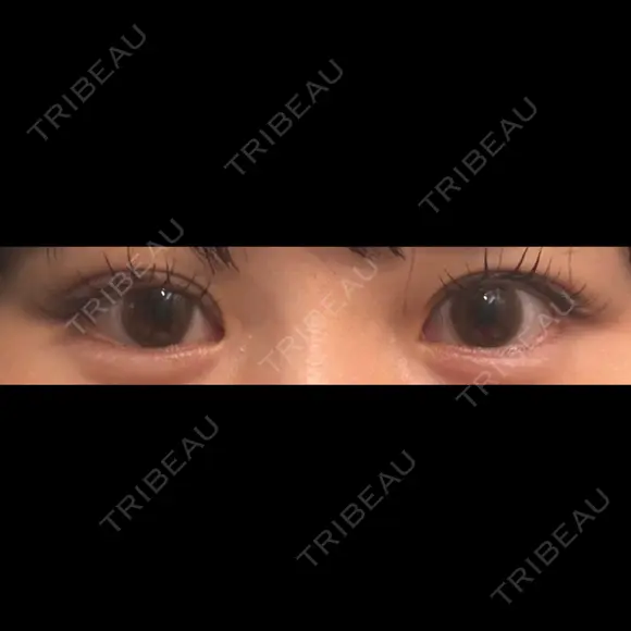 二重埋没 / 眼瞼下垂（非切開） SOL CLINIC AFTER メイン用