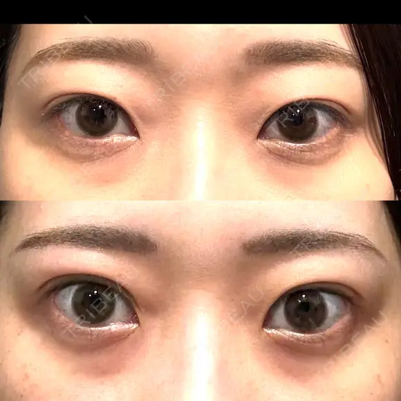 二重埋没 湘南美容クリニック 池袋東口院 AFTER メイン用