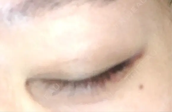 ヒアルロン酸注入（涙袋） アネシス美容クリニック AFTER メイン用