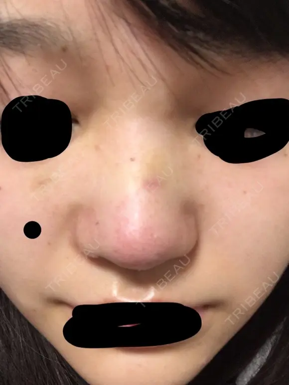 鼻尖形成（切開） 三輪皮フ科形成外科 DAY 5 メイン用