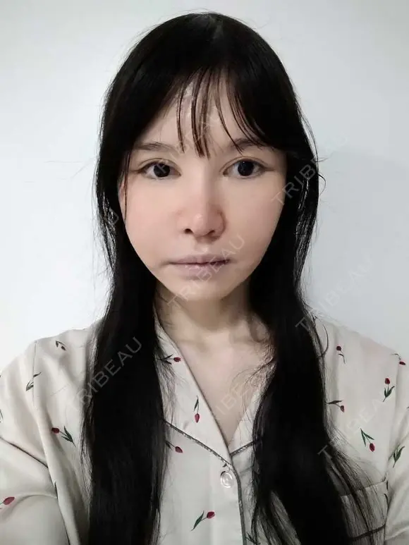 鼻修正 / 切開リフト / 鼻翼基部形成（貴族手術） リッツ美容外科 東京院 DAY 28 メイン用