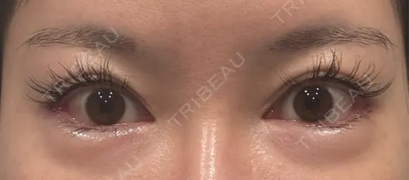 目尻切開 / タレ目形成・グラマラスライン（埋没） / 美容点滴・美容注射（美肌） LOUIS CLINIC 二子玉川院【ルイクリニック】 DAY 2 メイン用