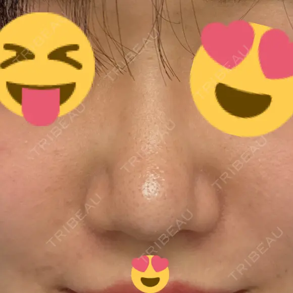 鼻尖形成（切開） / 軟骨移植 / 鼻尖縮小 / 鼻翼基部形成（貴族手術） / ヒアルロン酸注入（鼻翼基部） 東京シンデレラ美容外科 新宿院 AFTER メイン用