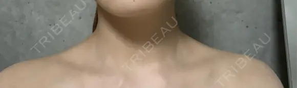 ボトックス（肩） ルラ美容クリニック 札幌本院 DAY 2 メイン用