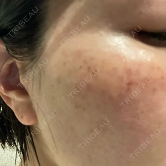 イオン導入 / ルメッカ ルラ美容クリニック 大宮院 / ルラスキンクリニック 大宮院 DAY 0 メイン用